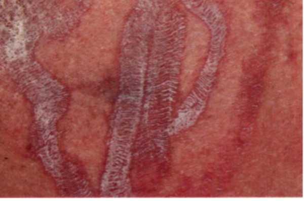 Skin marks from a box jellyfish sting: Frosted Ladder.
